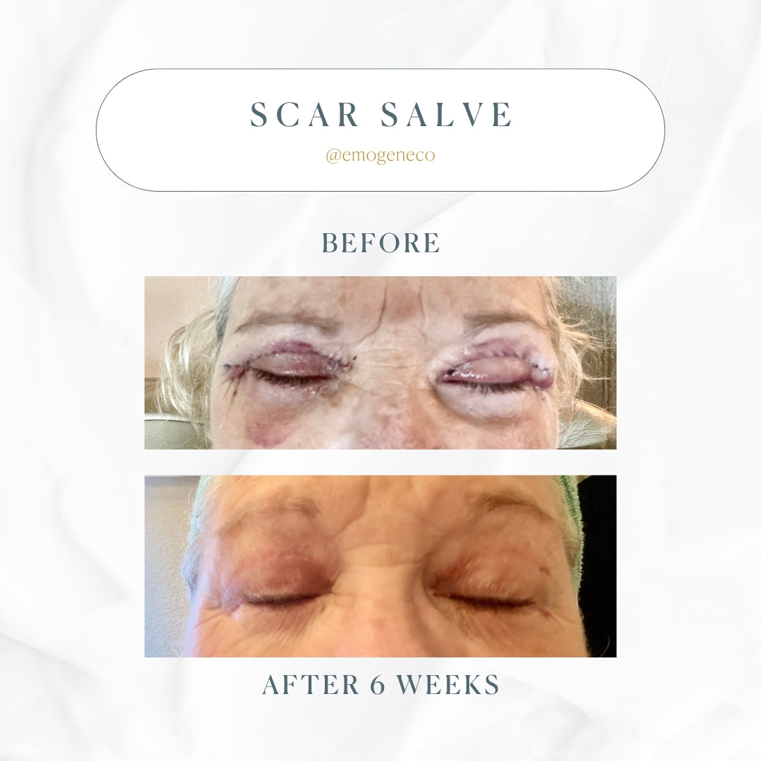Emogene Signature Scar Salve