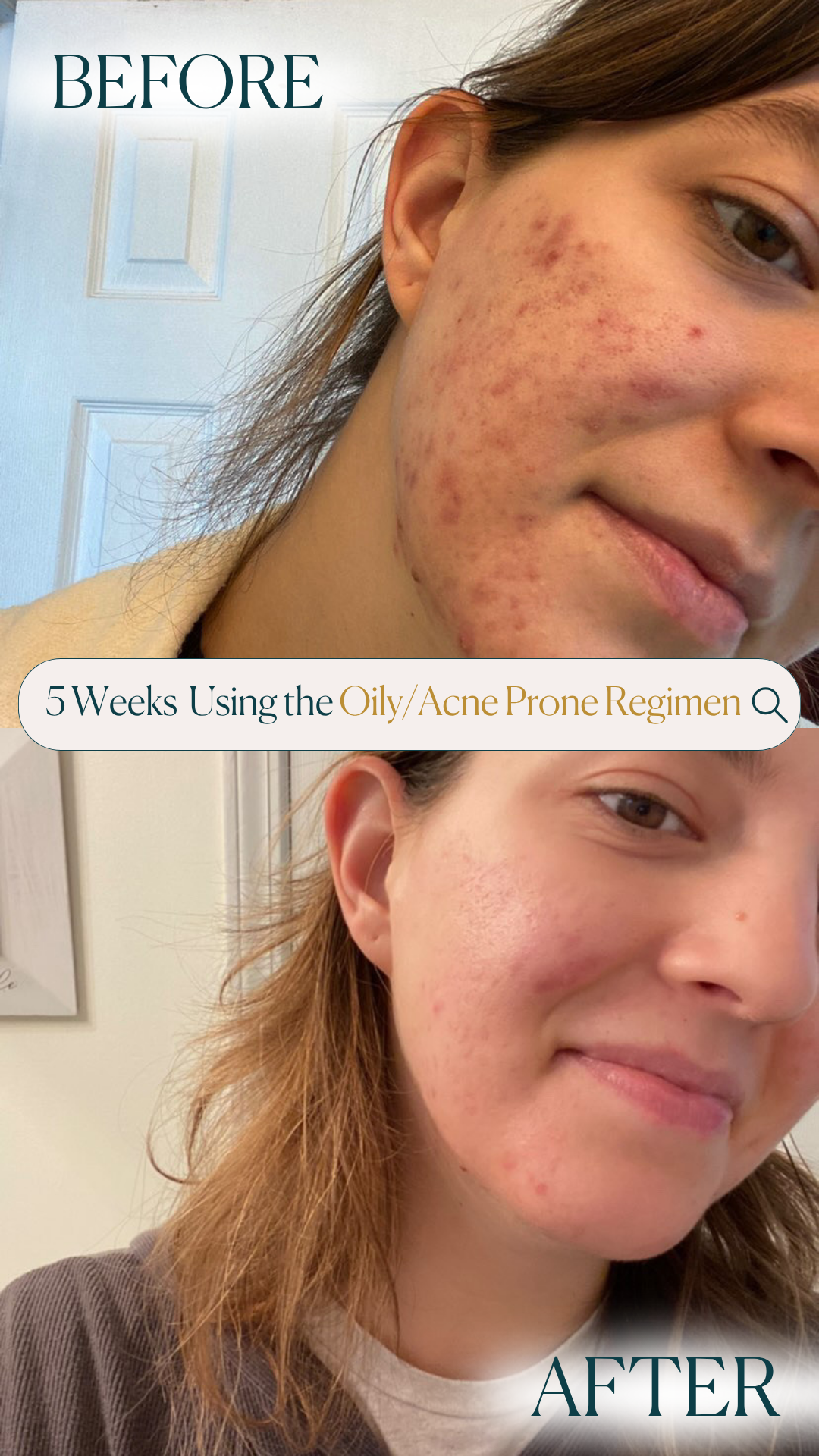 Oily / Acne Prone Skin Basic Regimen